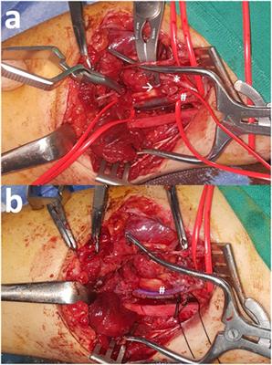 Management of Peripheral and Truncal Venous Injuries